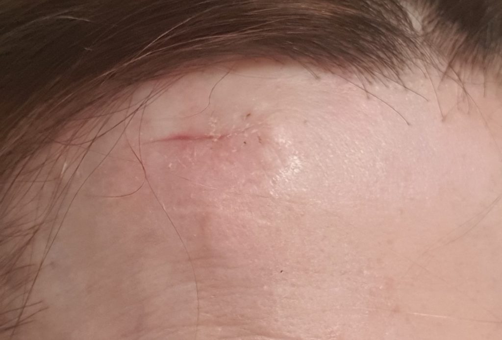 Skin cancer scar 19 days after