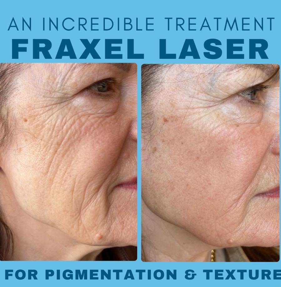 Fraxel before and after close up